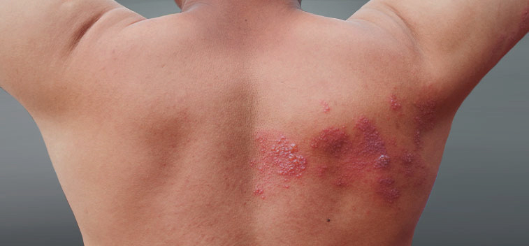 patient experiencing Post-Herpetic Neuralgia and in need of the neuropathy treatment protocol at Well Being Neuropathy Relief Center in Roseville